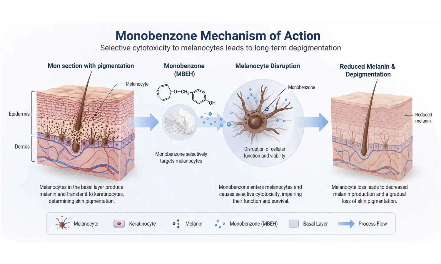 monobenzone-mechanism-depigmentation monobenzone-mechanism-depigmentation